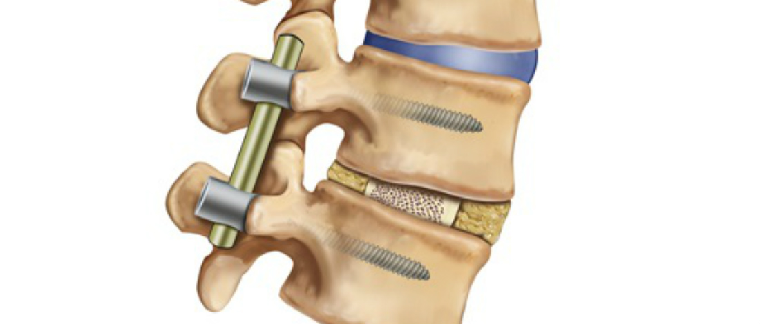 В одном из центров Москвы провели малоинвазивную операцию по лечению перелома пятого поясничного позвонка под рентгеновским контролем