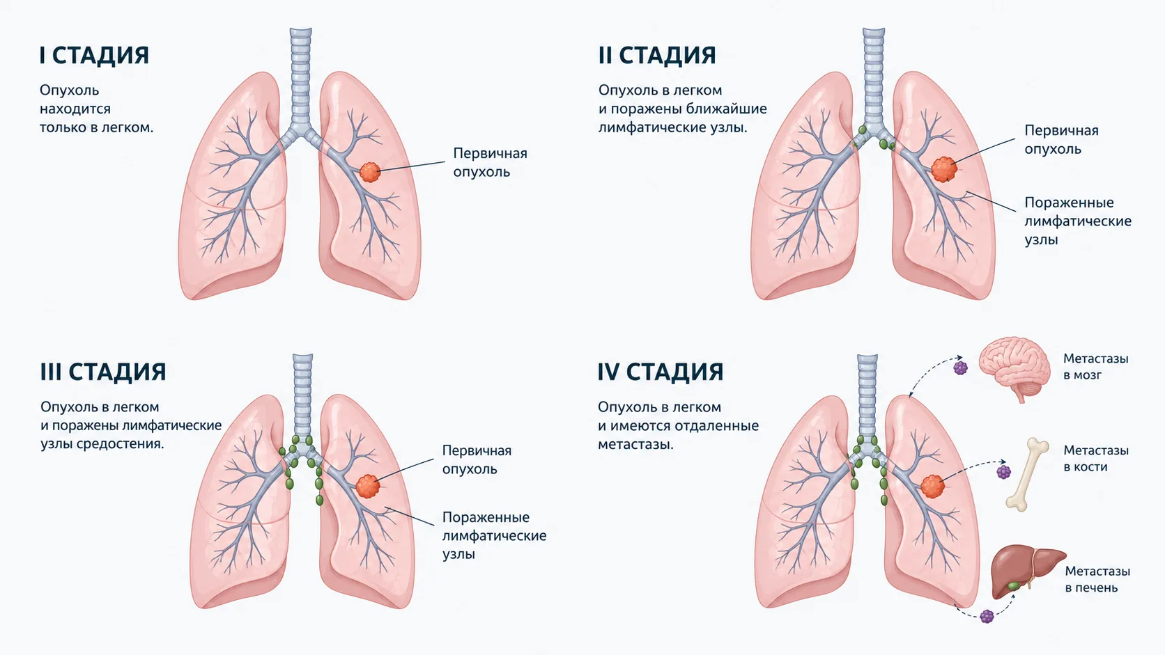 Стадии рака легких