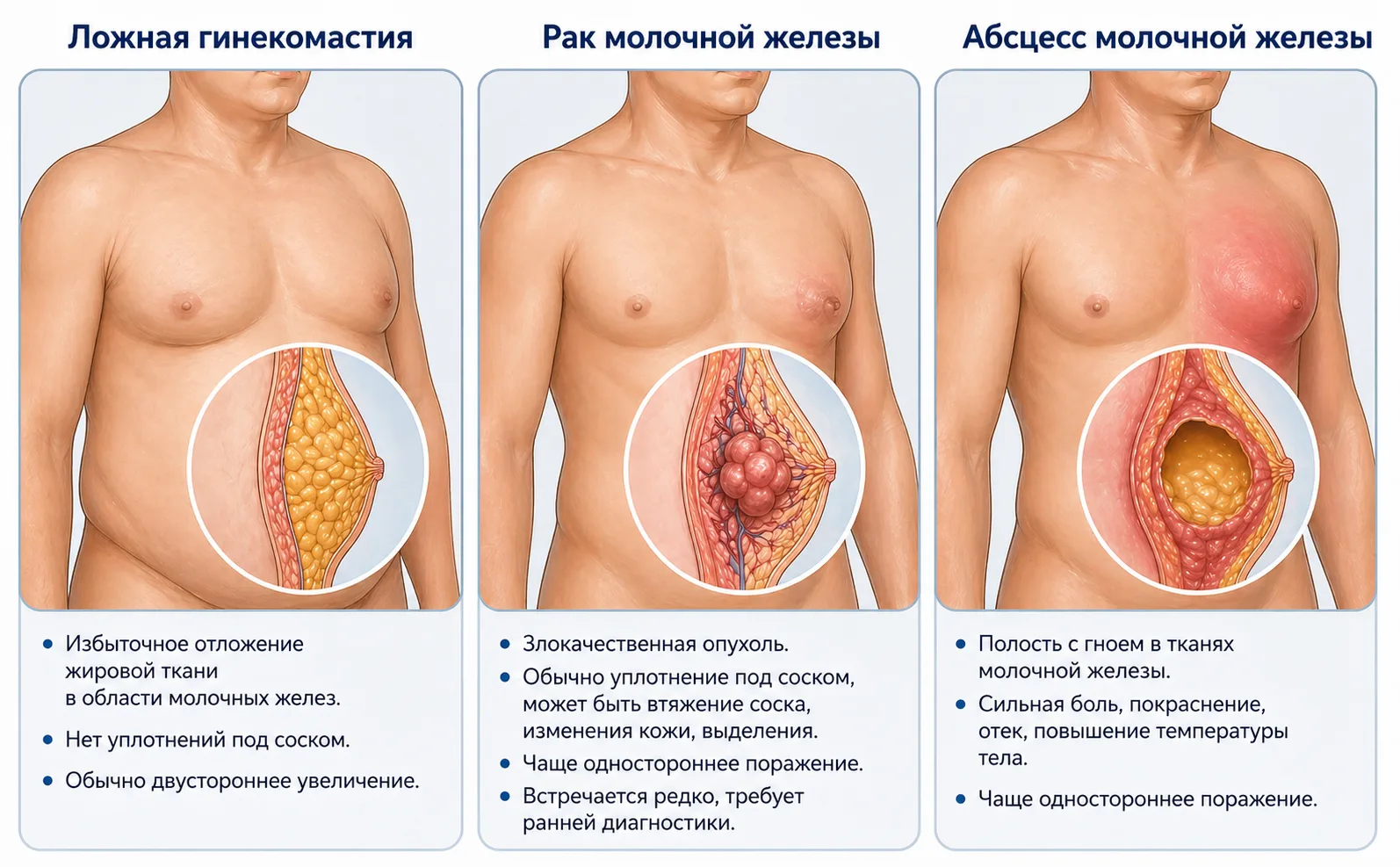 Медицинская инфографика: заболевания груди у мужчин