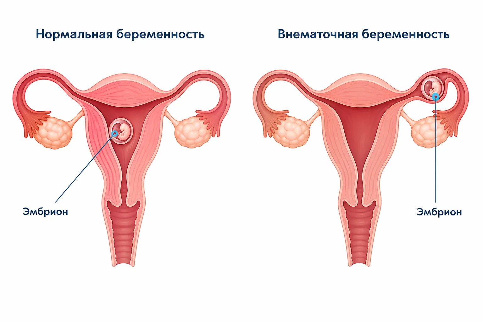 Нормальная и внематочная беременность