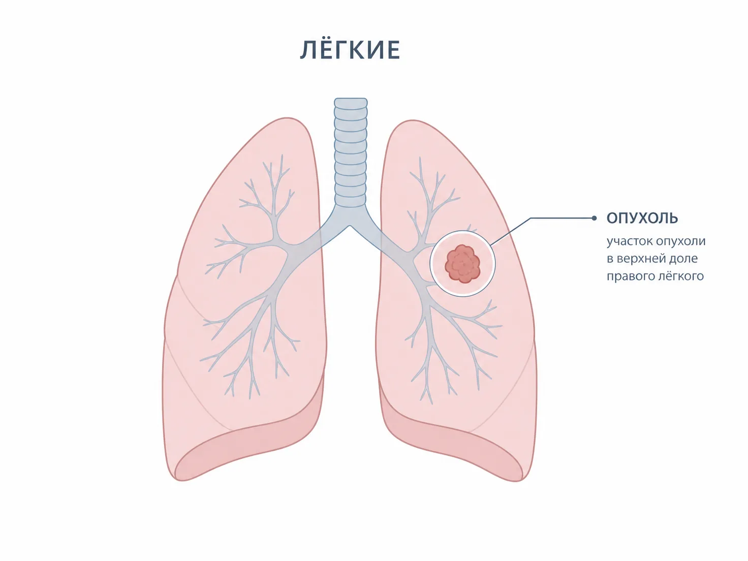 Схема крупноклеточного рака лёгкого