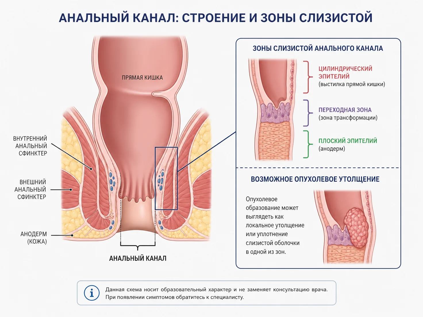 Схема анального канала при опухоли