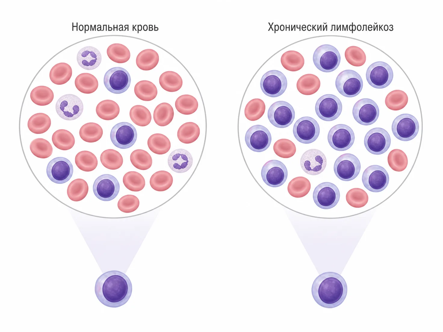 Схема лимфоцитов при хроническом лимфолейкозе