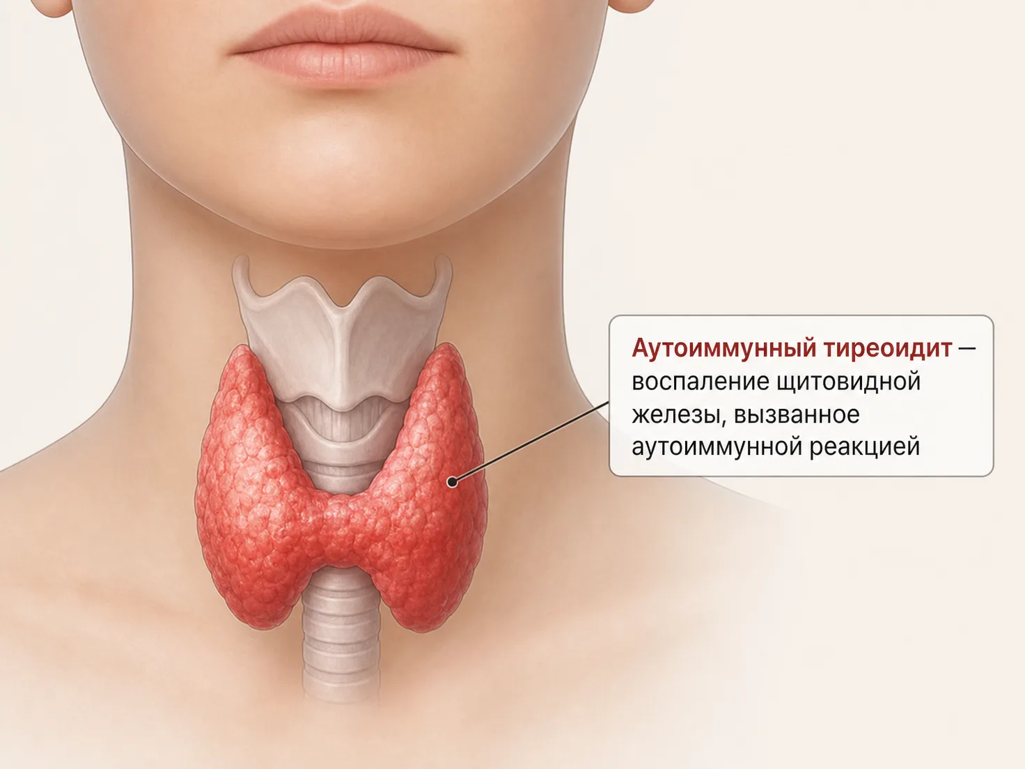 Схема щитовидной железы при аутоиммунном тиреоидите