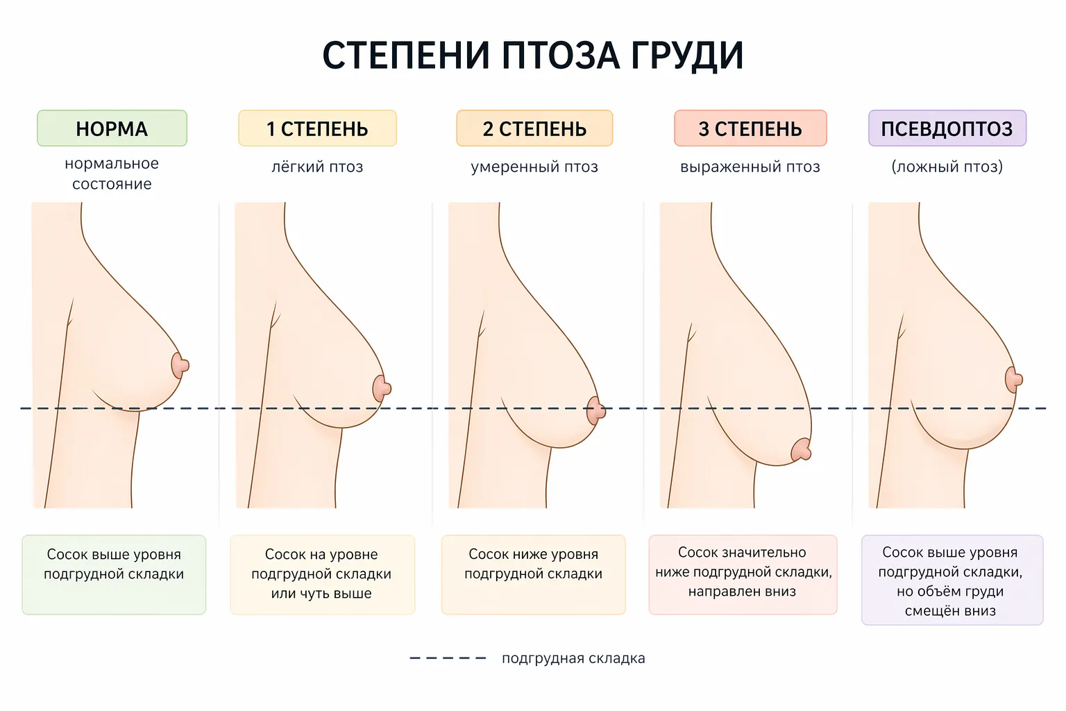 Степени птоза груди