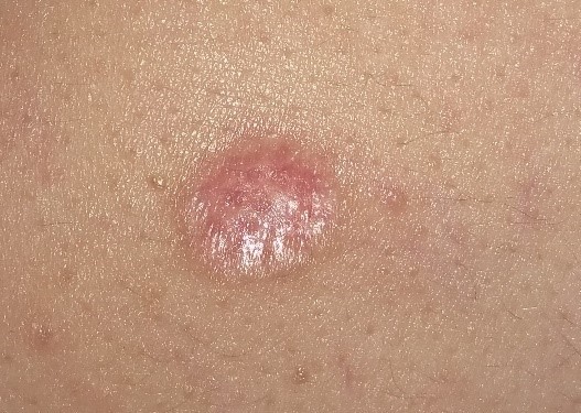 10-15 суток после удаления