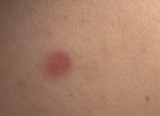 20-35 суток после удаления