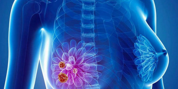 4-ст-рак-груди40119