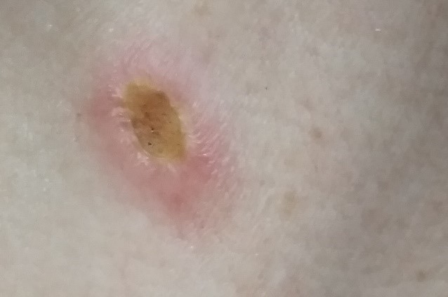 5-8 суток после удаления