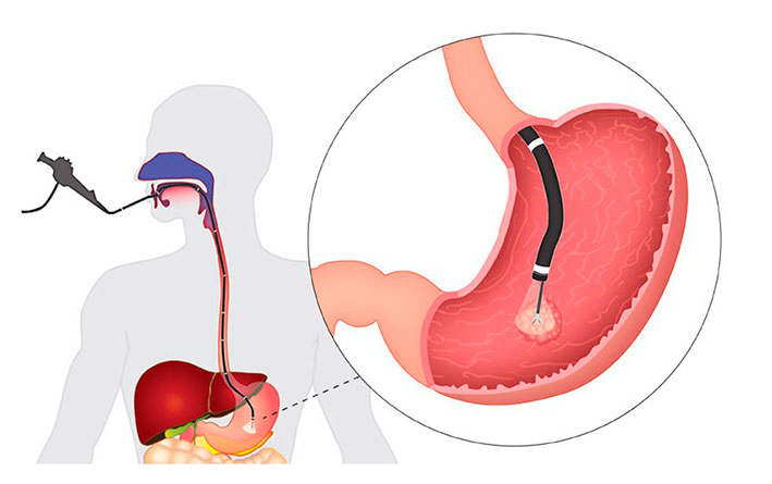 gastroskopiya-protsess