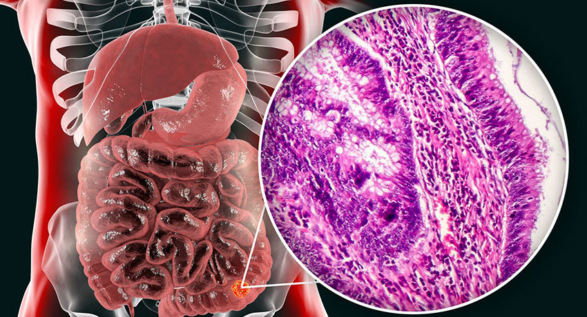 Аденокарцинома