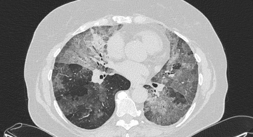 Аденокарцинома на снимке