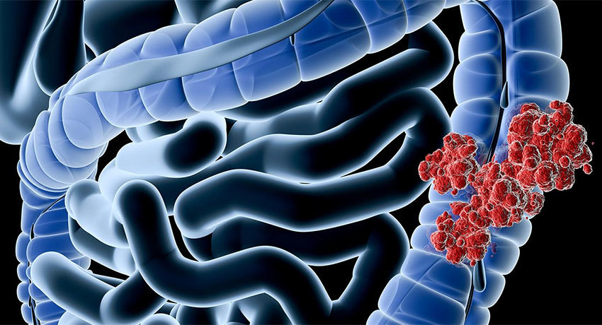 Аденокарцинома кишечника