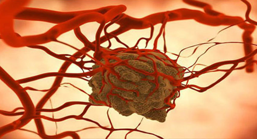 Ангиосаркома