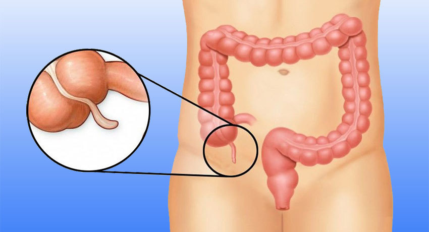 Аппендицит