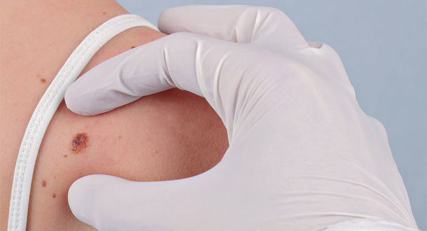 Удаление базалиомы