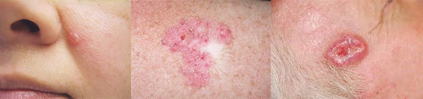 Примеры базалиомы