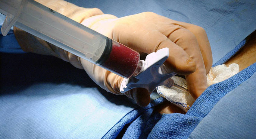 Биопсия костного мозга