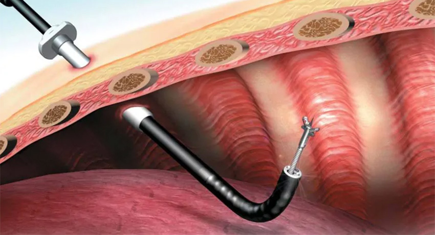 Биопсия легкого