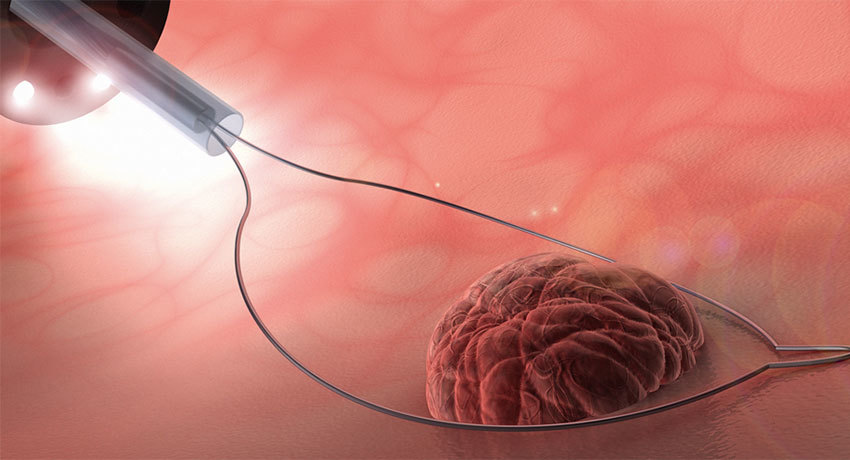 Биопсия пищевода