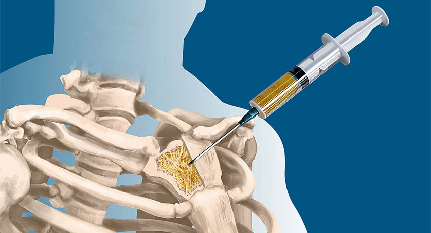 Биопсия кости