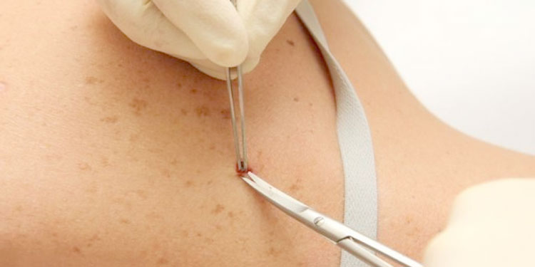 биопсия-кожи