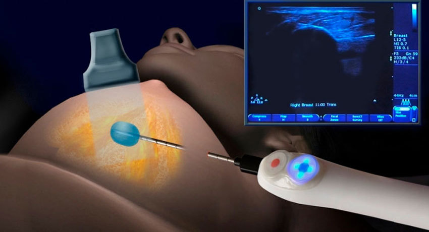 Биопсия молочной железы