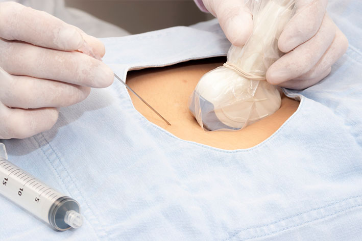 biopsiya-molochnoj-zhelezy-mastopatiya