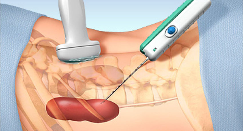 Биопсия почки