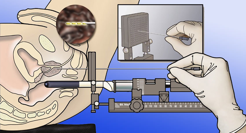 Биопсия простаты