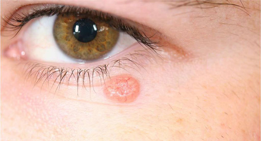 Признаки рака кожи