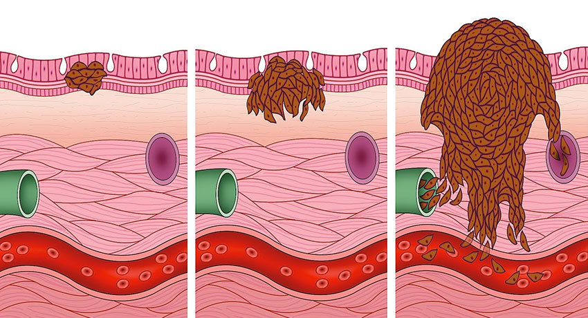 Признаки рака кожи