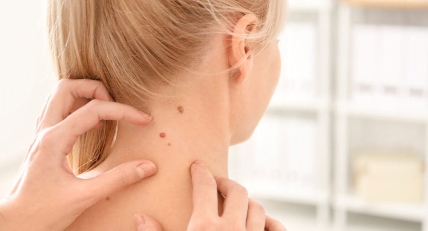 Диагностика рака кожи