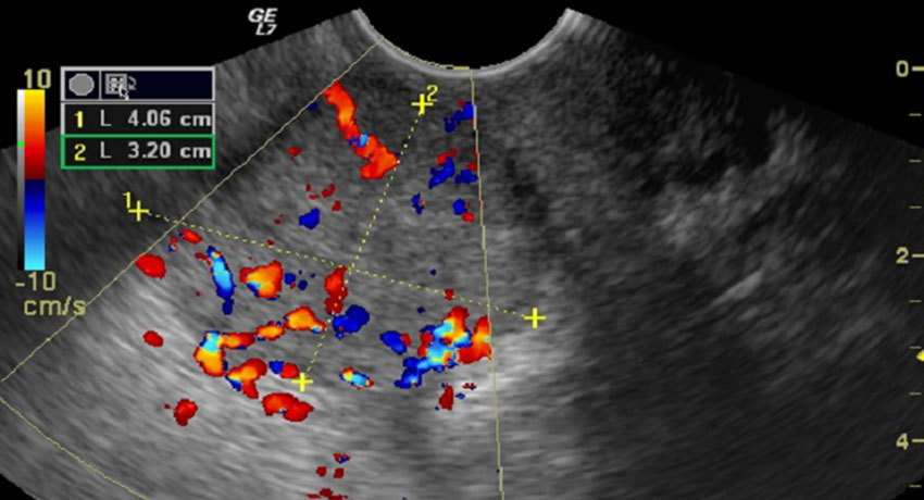 ПЭТ-КТ при раке матки