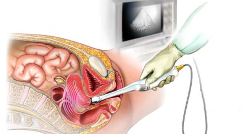 Ультразвуковое исследование матки