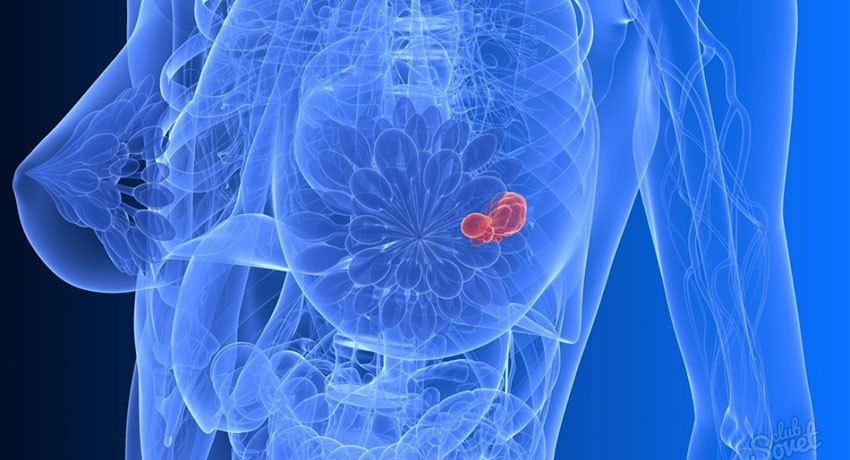 Рак молочной железы