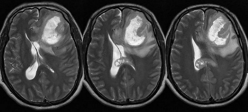 Рак головного мозга