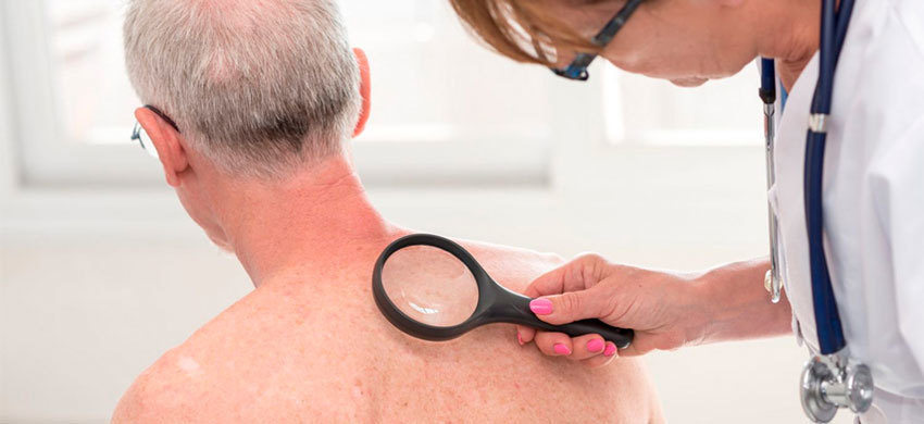 Лечение плоскоклеточного рака кожи