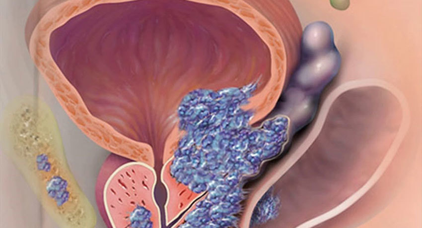 Рак простаты
