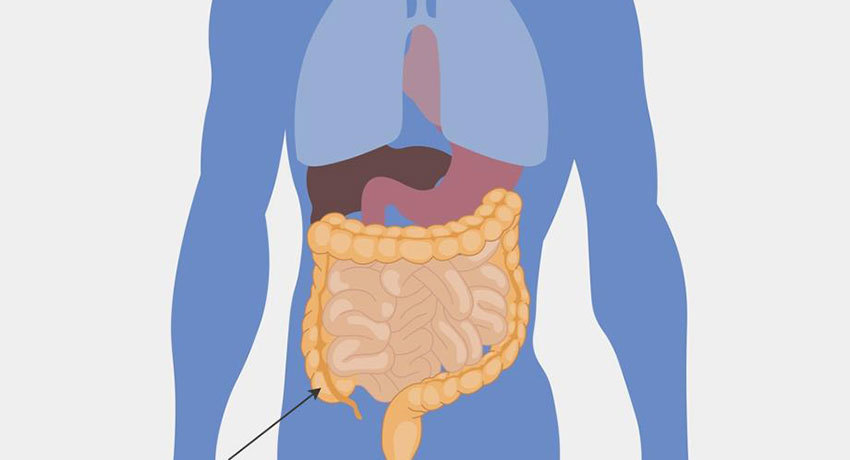 Рак слепой кишки