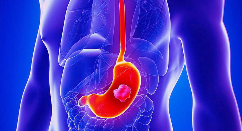 Карцинома желудка