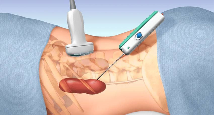Чрескожная биопсия образований брюшной полости и забрюшинного пространства