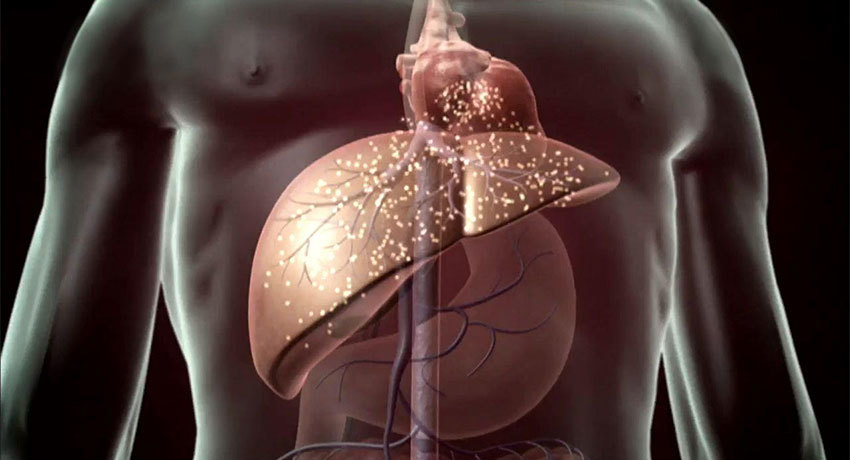 Цирроз печени