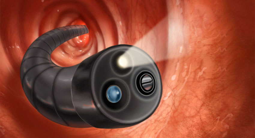 Колоноскопия