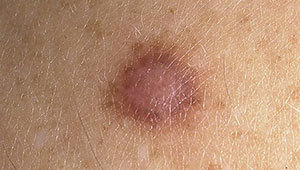 дерматофибромы