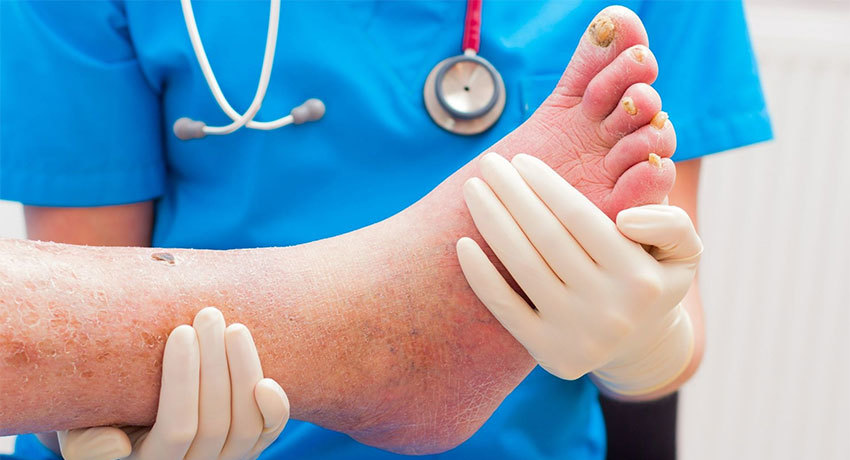 Лечение диабетической стопы