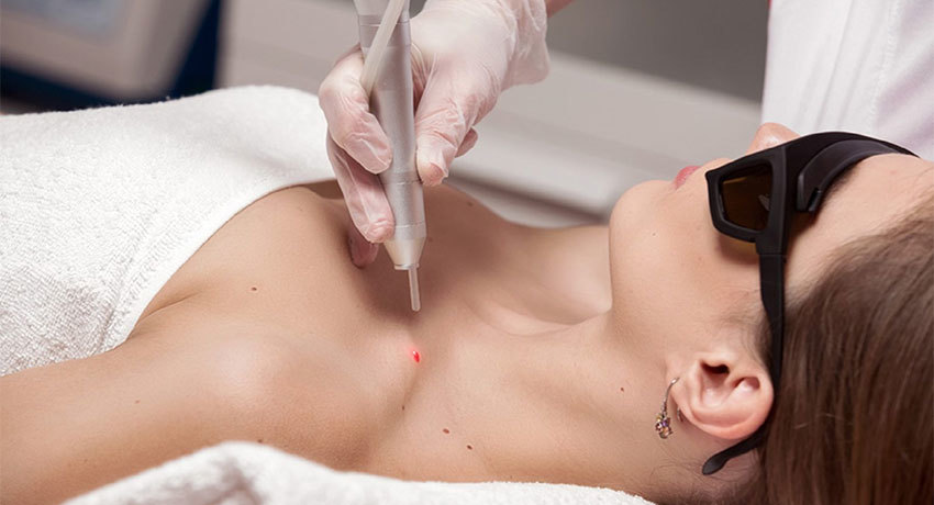 Удаление доброкачественного новообразования на коже