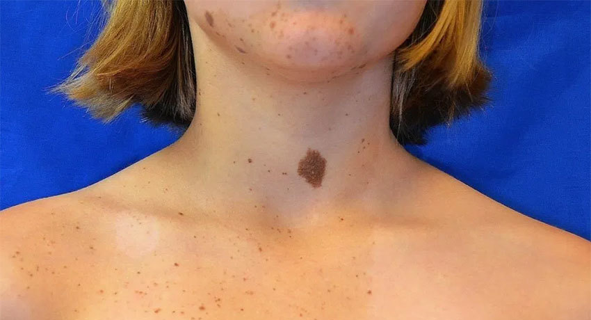 Пигментные невусы