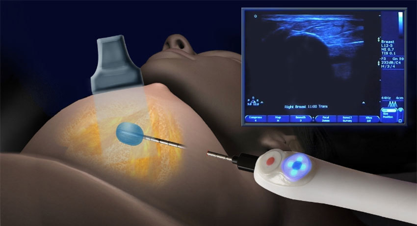 Эксцизионная и инцизионная биопсия