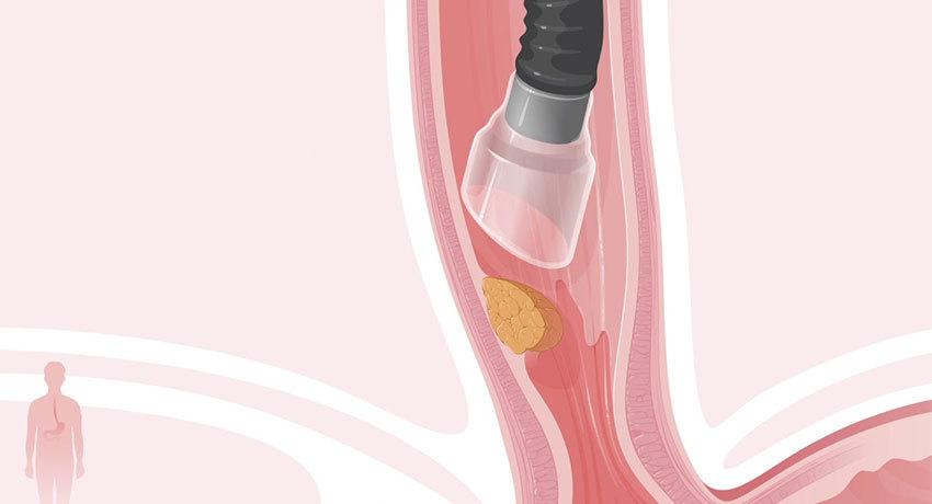 Эндоскопическая подслизистая диссекция при раннем раке